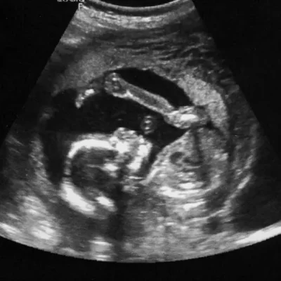 WHAT TO EXPECT FROM AN EARLY ULTRASOUND SCAN