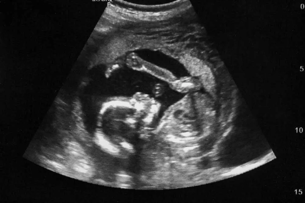 WHAT TO EXPECT FROM AN EARLY ULTRASOUND SCAN